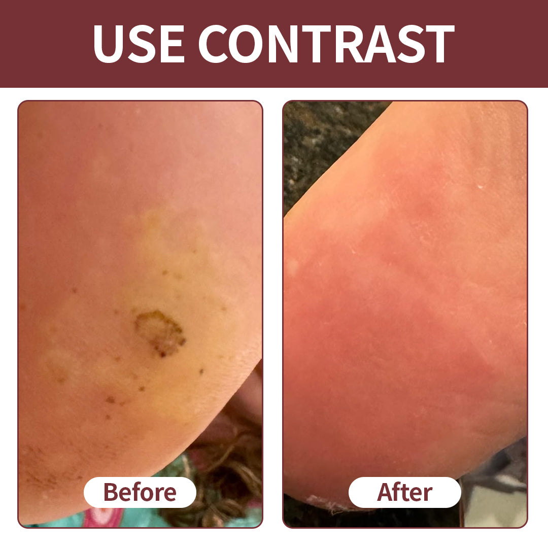 BBOJI® KeraErase Dual-Action Renewal Cream | Black Rice Skin Repair Essence Cream (Removes warts and skin growths, improves keratin buildup and seborrheic dermatitis, follicular keratosis, age spots, and bruising)