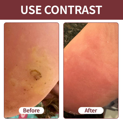 BBOJI® KeraErase Dual-Action Renewal Cream | Black Rice Skin Repair Essence Cream (Removes warts and skin growths, improves keratin buildup and seborrheic dermatitis, follicular keratosis, age spots, and bruising)