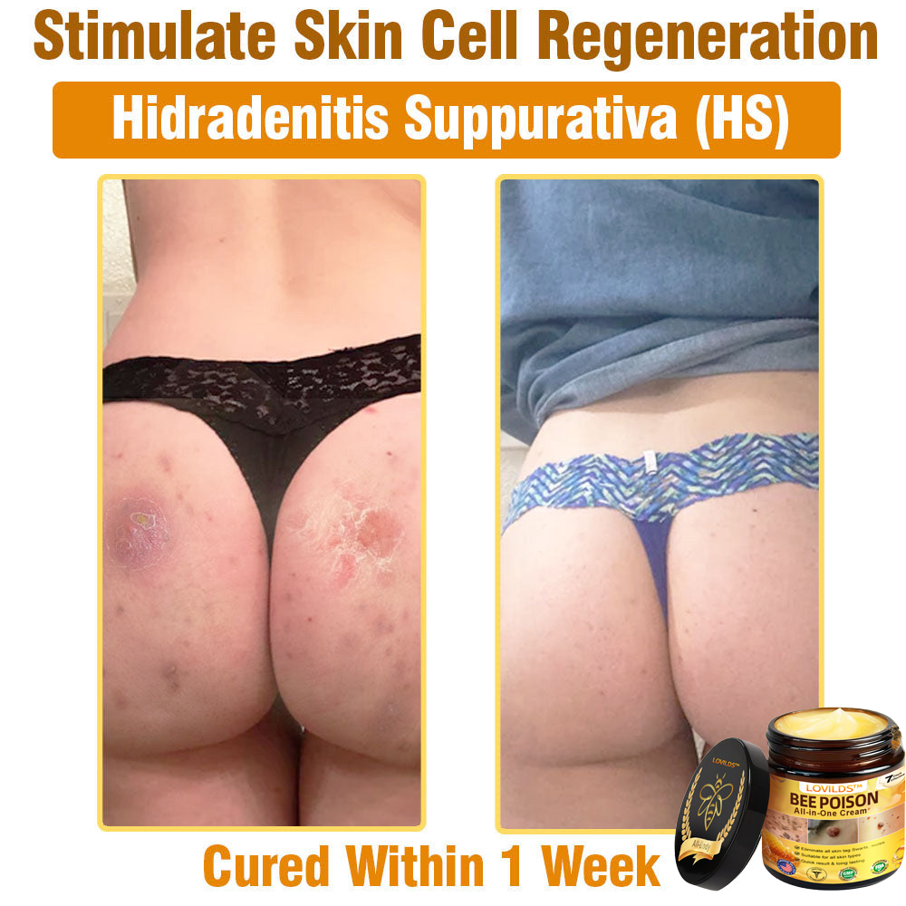 LOVILDS™ Bee Poison All-in-One Cream US Dermatologist Approved